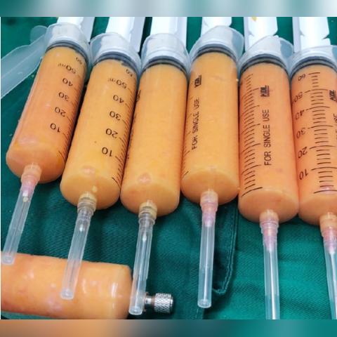 最新注射隆胸技术，重塑胸部形态的优选方案